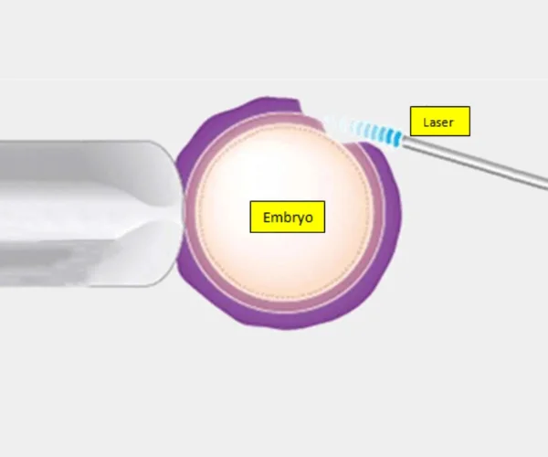 Laser assisted hatching