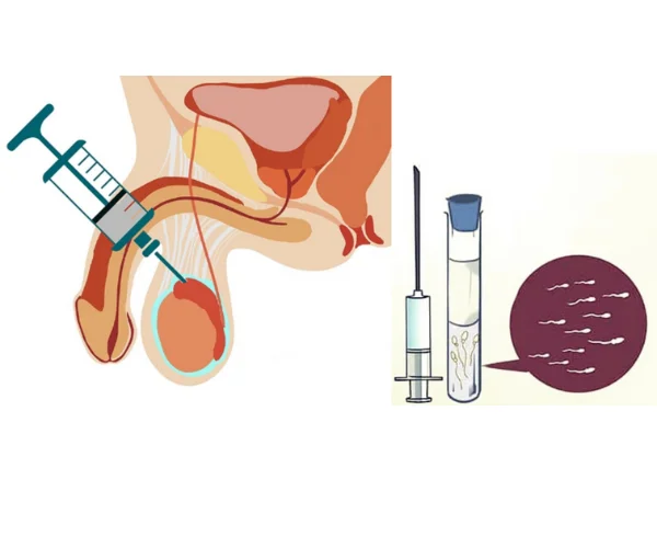 Surgical sperm retrieval TESA PESA